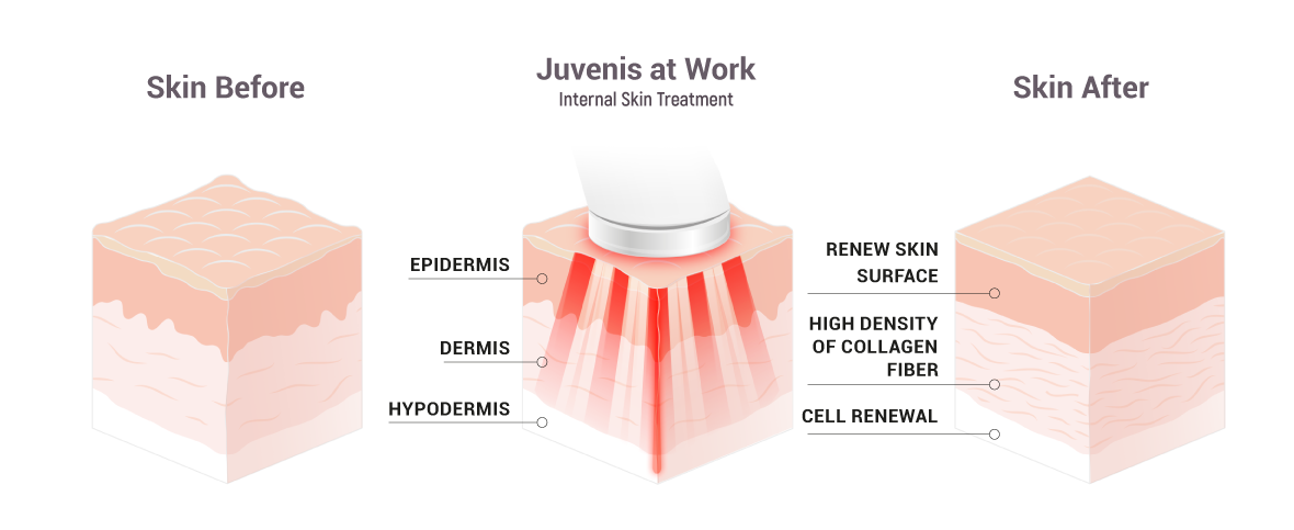 Juvenis anti-aging device