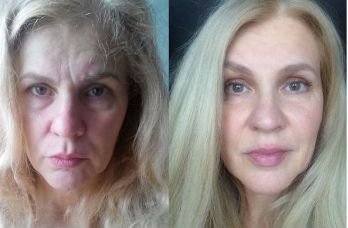Risultato Natural Lift, ginnastica facciale e lifting naturale senza filler.
