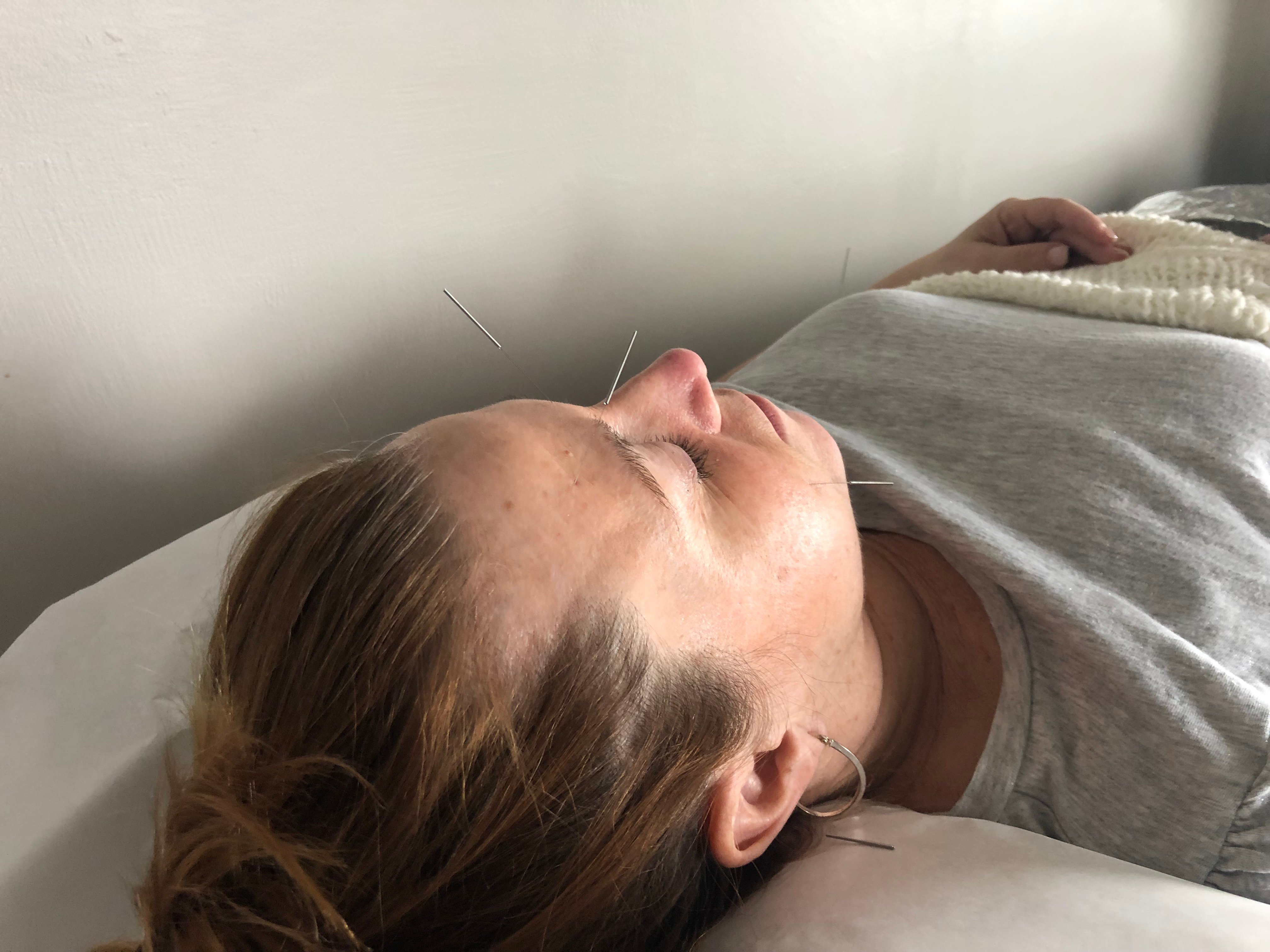 Acupuncture
