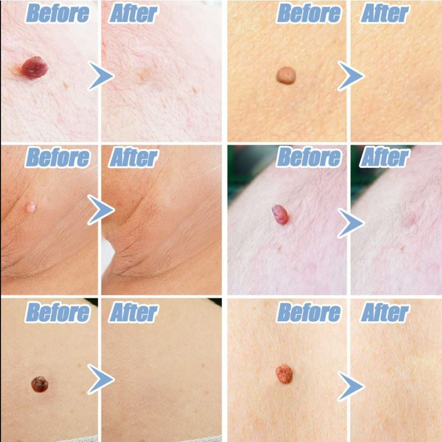 Remove Unwanted Skin Tags from the Comfort of Home!  Tired of skin tags affecting your confidence or getting caught on clothing and jewelry? The Painless Skin Tag Removal Kit offers a simple, convenient solution for safe at-home skin tag treatment. Designed to help you address unwanted skin tags without the hassle of scheduling appointments, this easy-to-use kit can help you achieve smoother, clearer-looking skin from the comfort of your own home.  Why Choose the Painless Skin Tag Removal Kit?  ✅ Easy-to-use at-home treatment  ✅ Designed for comfort and convenience  ✅ Suitable for common skin tag areas  ✅ No expensive clinic visits required  ✅ Helps restore confidence in your appearance  Whether you have one skin tag or several, this kit provides a practical option for those looking for an affordable and effective way to improve the look of their skin.  Imagine the Difference  ✔ No more skin tags catching on clothing  ✔ No more feeling self-conscious in photos  ✔ No more putting off treatment  ✔ Enjoy smoother-looking skin and greater confidence  Thousands of people are searching for a simple way to deal with unwanted skin tags. Now you can take action from the comfort of your own home with a solution designed to make the process as straightforward as possible.  Limited-Time Opportunity  If you've been thinking about removing unwanted skin tags, now is the perfect time to get started. Don't let skin tags continue to distract you from feeling your best.  👉 Get your Painless Skin Tag Removal Kit today and take the first step toward smoother, clearer-looking skin.  Click the link below to order now and learn more!  #SkinTagRemoval #PainlessSkinTagRemoval #SkinCare #HealthySkin #AtHomeTreatment #BeautyCare #ConfidenceBoost #SmoothSkin #SelfCare #SkinHealth #BeautyProducts #ClearSkin #HomeBeautySolutions #SkinTagTreatment #ShopNow