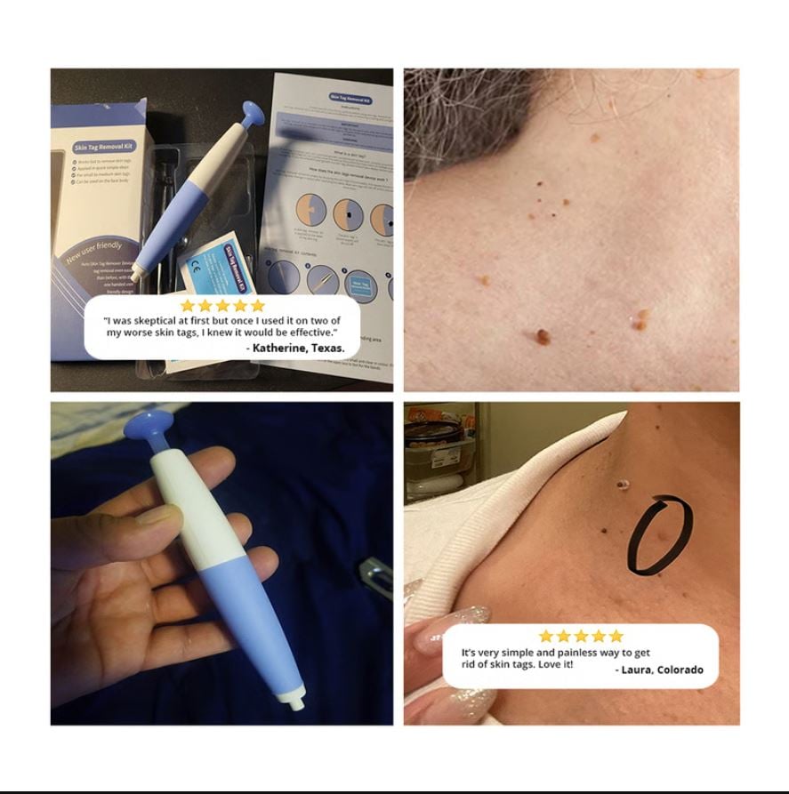 Remove Unwanted Skin Tags from the Comfort of Home!  Tired of skin tags affecting your confidence or getting caught on clothing and jewelry? The Painless Skin Tag Removal Kit offers a simple, convenient solution for safe at-home skin tag treatment. Designed to help you address unwanted skin tags without the hassle of scheduling appointments, this easy-to-use kit can help you achieve smoother, clearer-looking skin from the comfort of your own home.  Why Choose the Painless Skin Tag Removal Kit?  ✅ Easy-to-use at-home treatment  ✅ Designed for comfort and convenience  ✅ Suitable for common skin tag areas  ✅ No expensive clinic visits required  ✅ Helps restore confidence in your appearance  Whether you have one skin tag or several, this kit provides a practical option for those looking for an affordable and effective way to improve the look of their skin.  Imagine the Difference  ✔ No more skin tags catching on clothing  ✔ No more feeling self-conscious in photos  ✔ No more putting off treatment  ✔ Enjoy smoother-looking skin and greater confidence  Thousands of people are searching for a simple way to deal with unwanted skin tags. Now you can take action from the comfort of your own home with a solution designed to make the process as straightforward as possible.  Limited-Time Opportunity  If you've been thinking about removing unwanted skin tags, now is the perfect time to get started. Don't let skin tags continue to distract you from feeling your best.  👉 Get your Painless Skin Tag Removal Kit today and take the first step toward smoother, clearer-looking skin.  Click the link below to order now and learn more!  #SkinTagRemoval #PainlessSkinTagRemoval #SkinCare #HealthySkin #AtHomeTreatment #BeautyCare #ConfidenceBoost #SmoothSkin #SelfCare #SkinHealth #BeautyProducts #ClearSkin #HomeBeautySolutions #SkinTagTreatment #ShopNow